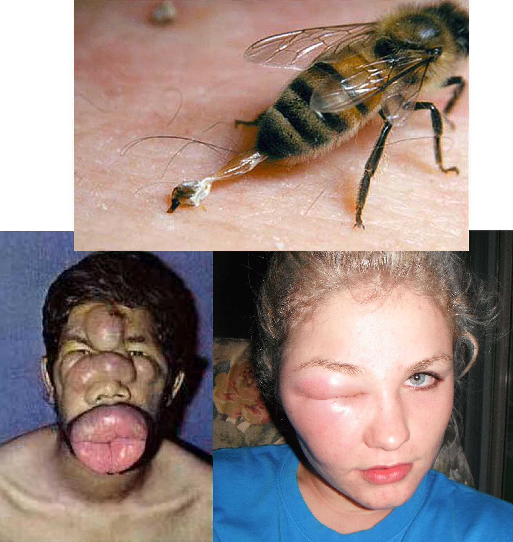 Are You Allergic To Insect Stings? Types Of Reactions ...